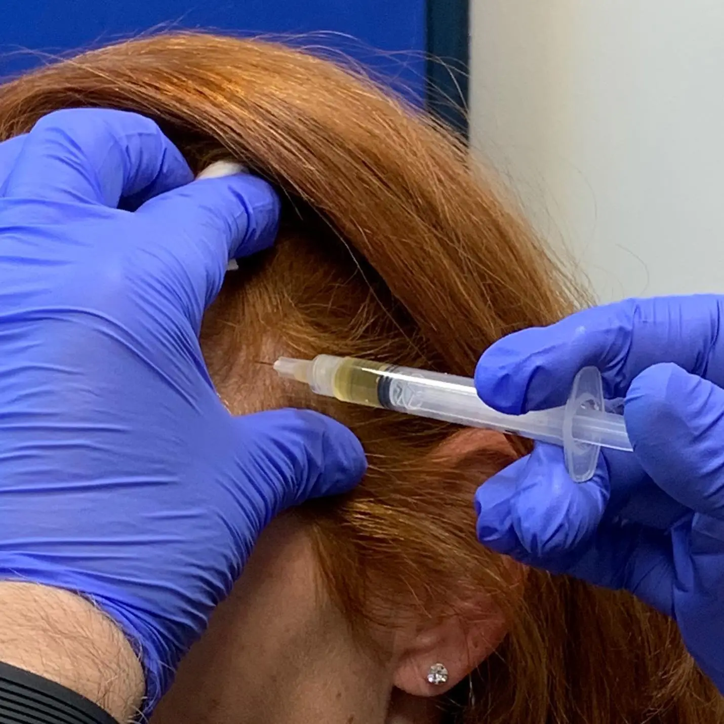 Clinician in blue gloves administering PRP injection to patient's scalp for hair restoration